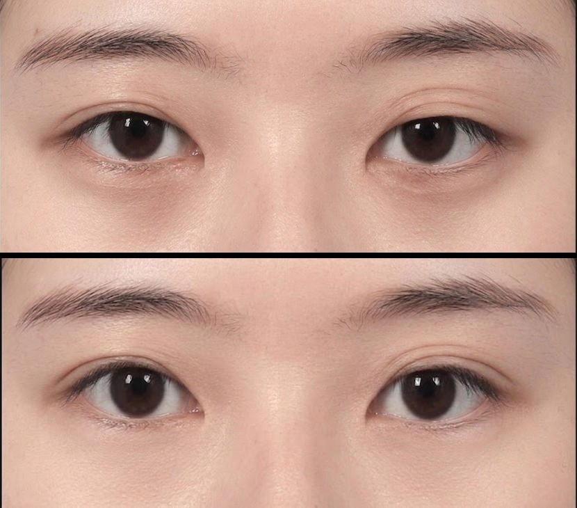 다크서클형